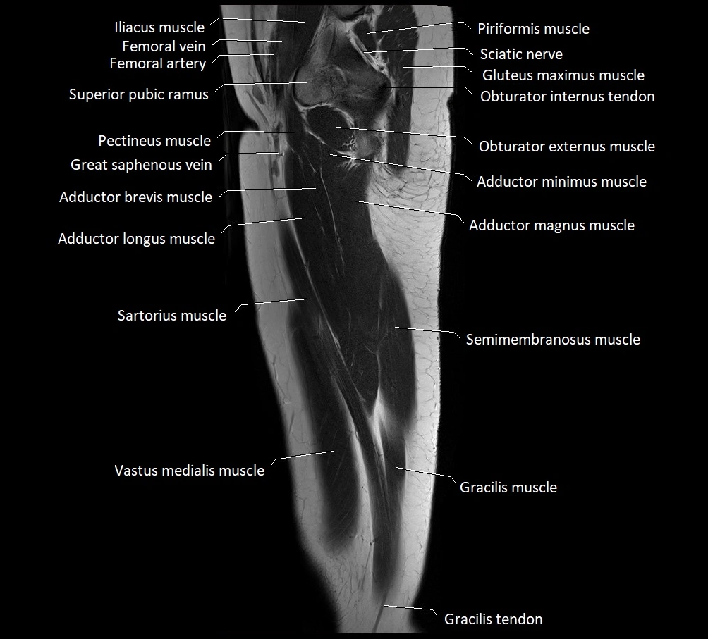 Thigh sagittal cross sectional anatomy MRI 3T image 16.webp